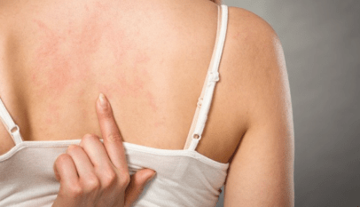 أسباب حكة الجسم المفاجئة عند النساء