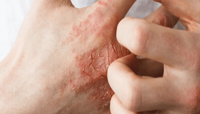 علاج الاكزيما