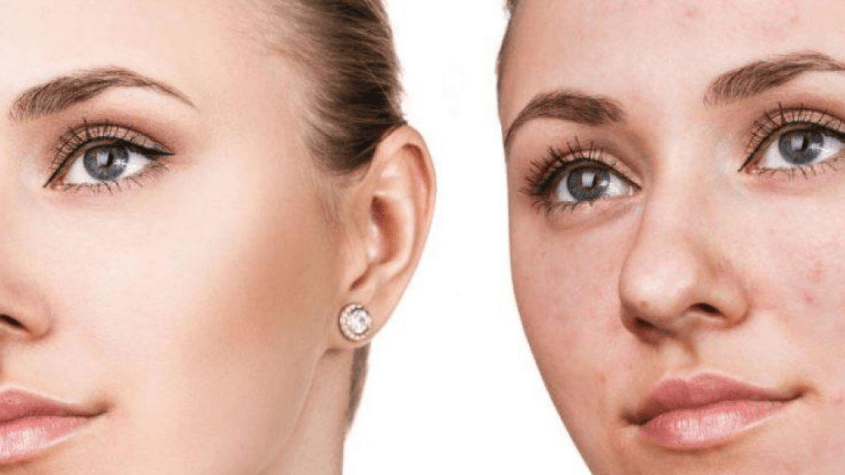 علاج حب الشباب للبشرة الدهنية