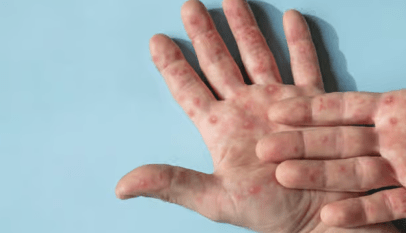 كيف تحمي نفسك من جدري القردة: دليل شامل للوقاية