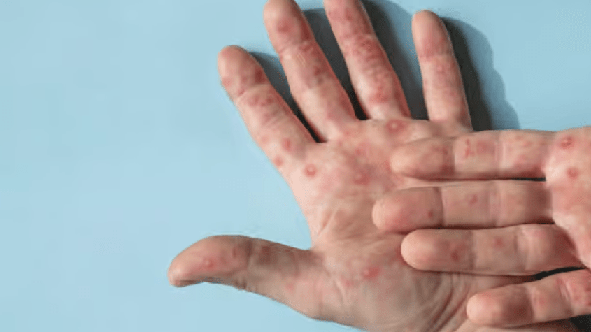 كيف تحمي نفسك من جدري القردة: دليل شامل للوقاية