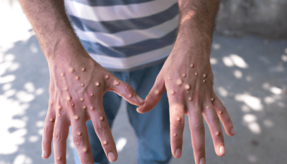 ما هو فيروس جدري القردة : أنواعه، وأعراضه، وكيفية علاجه؟