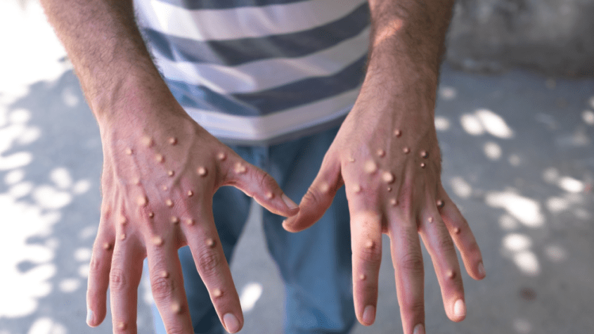 ما هو فيروس جدري القردة : أنواعه، وأعراضه، وكيفية علاجه؟