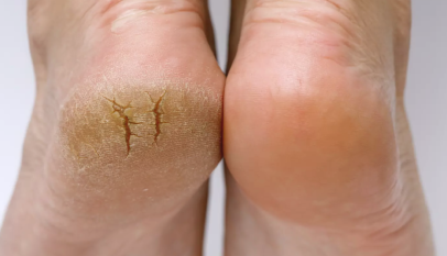 أسباب تشقق القدمين عند النساء