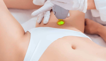 إزالة الشعر بالليزر للمنطقة الحساسة