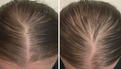 minoxidil للشعر