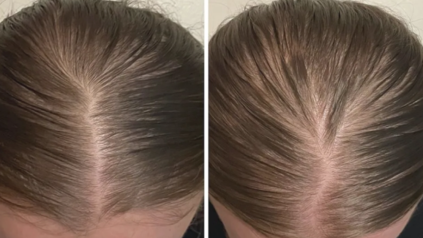 minoxidil للشعر