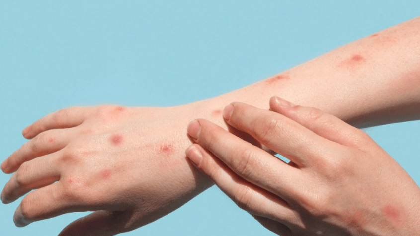 أعراض جدري القرود