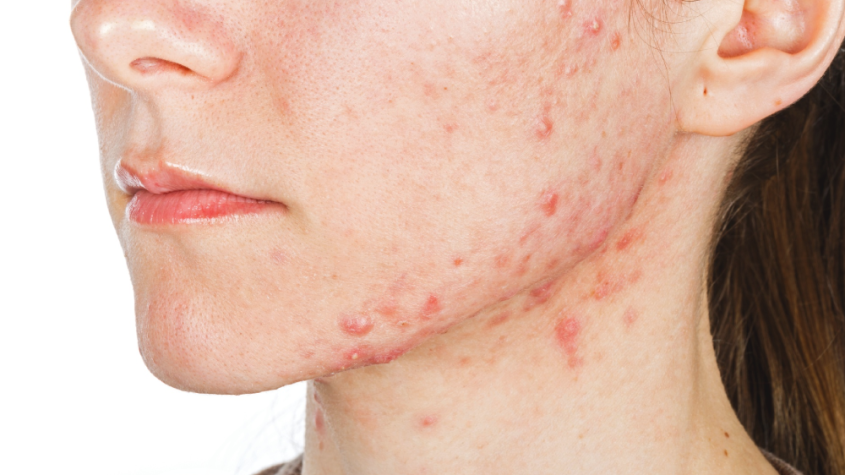 علاج حب الشباب الهرموني