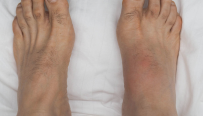 أسباب تورم القدمين