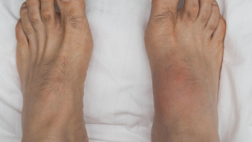 أسباب تورم القدمين